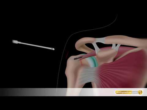 Schulter-OP: So wird ein Rotatorenmanschettenriss operiert