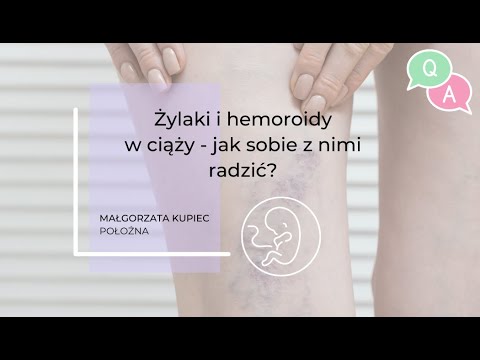 Żylaki i hemoroidy w ciąży - jak sobie z nimi radzić? - Q&A z położną Małgorzatą Kupiec