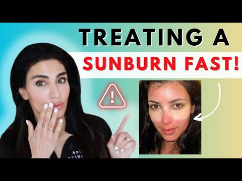 How to TREAT & Prevent a SUNBURN Fast! #sunburn #skincancer | Dr. Azadeh Shirazi