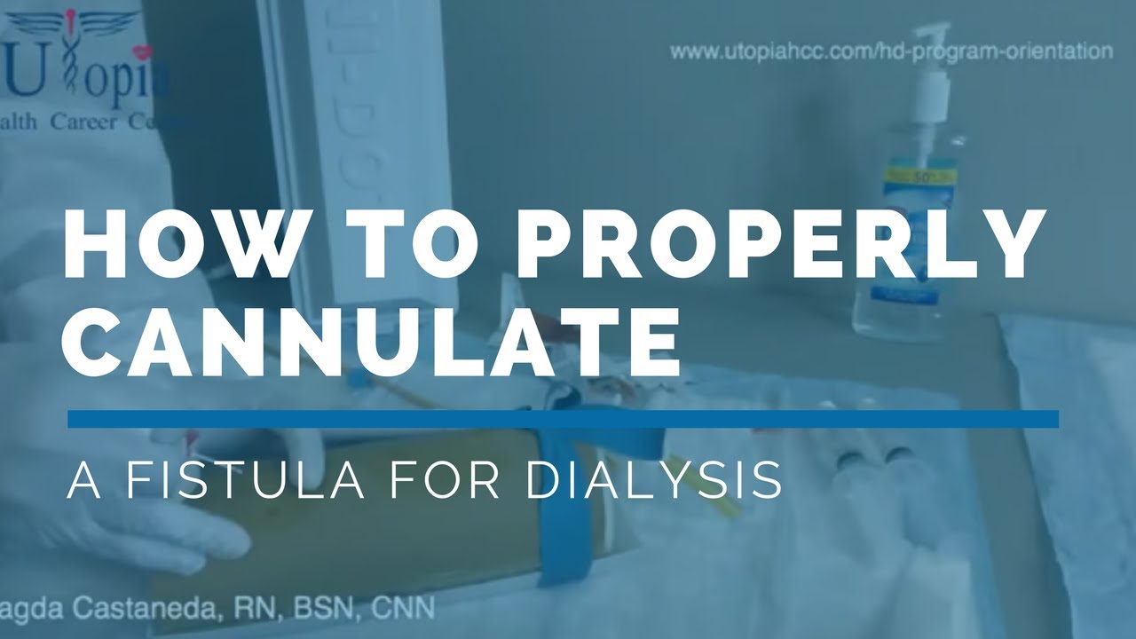 HOW TO PROPERLY CANNULATE A FISTULA in 2022