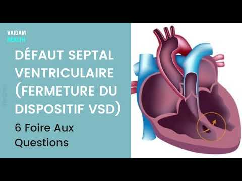 DÉFAUT SEPTAL VENTRICULAIRE (FERMETURE DU DISPOSITIF VSD)