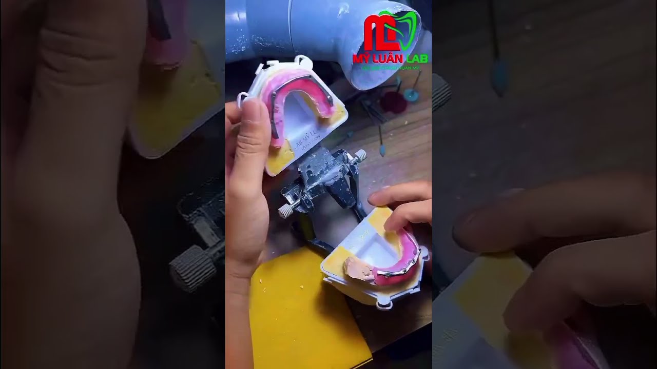 Quy Trình Gia Công Hàm Tháo Lắp Trên Thanh Bar Tại Mỹ Luân Dental Lab | Chính Xác – Thẩm Mỹ – Bền Vững