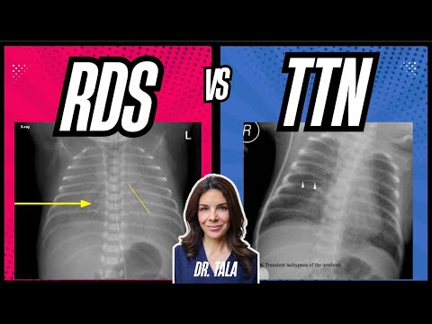 PLAY the GAME! Respiratory Distress Syndrome or Transient Tachypnea of the Newborn??!!!