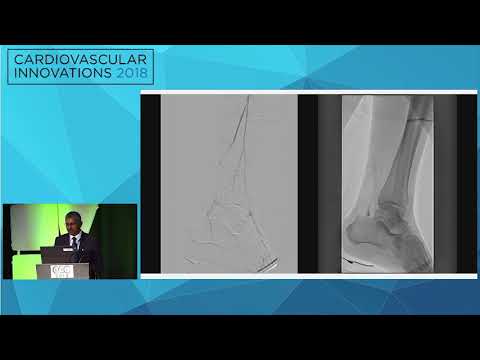 CVI2018 Session: Crossing SFA CTOs, is there an algorithm? - Subhash Banerjee, MD