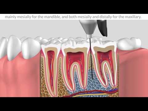 Protocole   intraosseous anesthesia