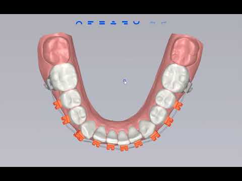 Designing a Custom Smile using Lightforce Software to create Custom, 3d Printed Ceramic Brackets