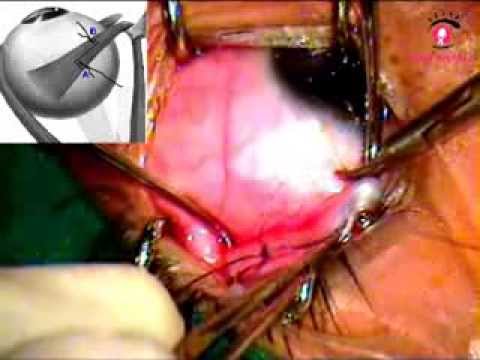Superior Oblique Split tendon Lengthening Surgery for Brown syndrome