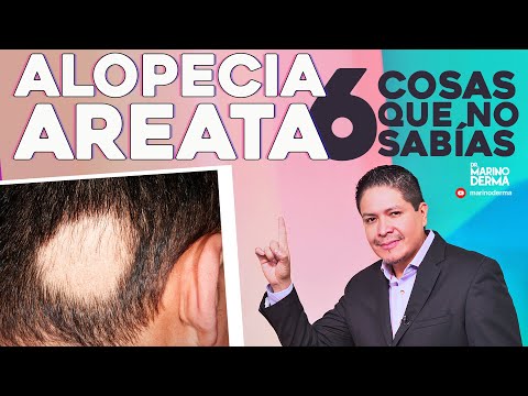 ALOPECIA AREATA 6 COSAS QUE NO SABIAS