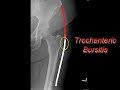 Hip arthroscopy for trochanteric bursitis - bursectomy