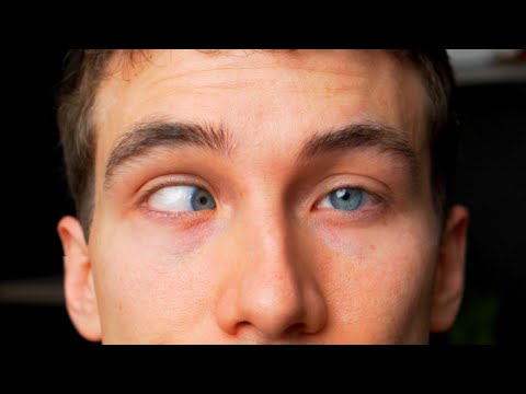 CROSS EYED? What is Strabismus - (Types, Causes, Treatments) Eye Doctor Explains