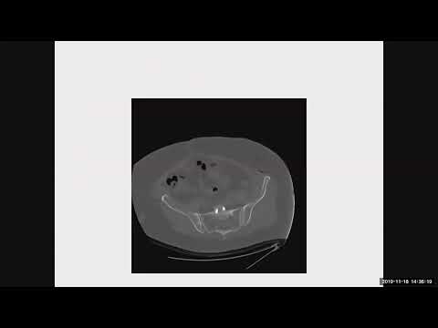 ALIF- Complication profile - My Worst Complication by David Polly