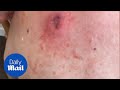 Gross moment a 25-year-old cyst is popped and oozes pus