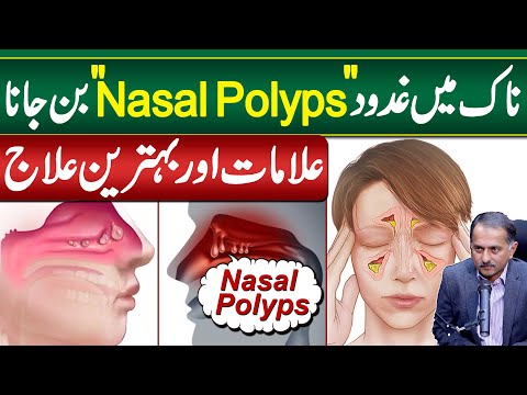 Gadood in Nose OR Nasal Polyps - Symptoms and Treatment of Nasal Polyps - Nose Polyps Ka ilaj