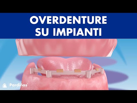 Overdenture su impianti ©