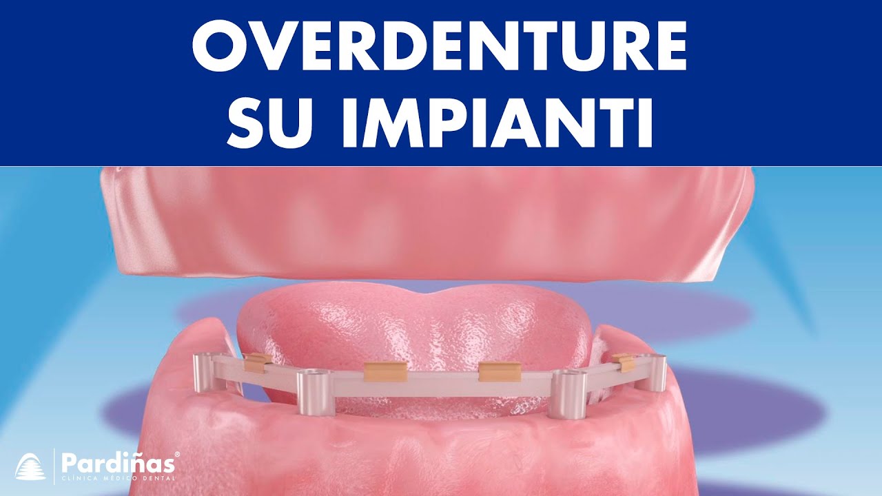 Watch Now Overdenture su impianti © Overdenture su impianti ©