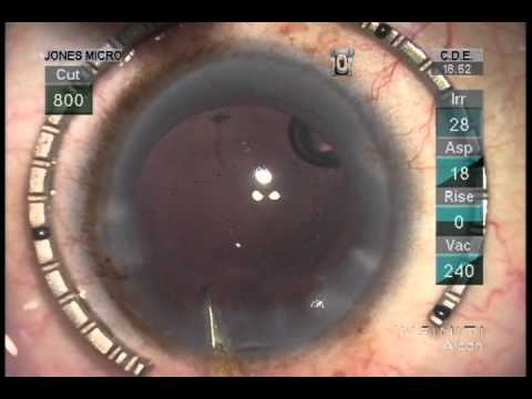 PC Rupture During Phaco