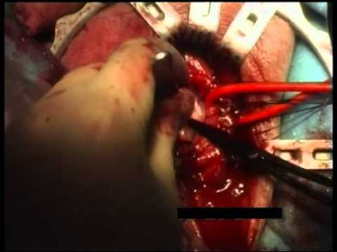 Urethroplasty Using Buccal Mucosa