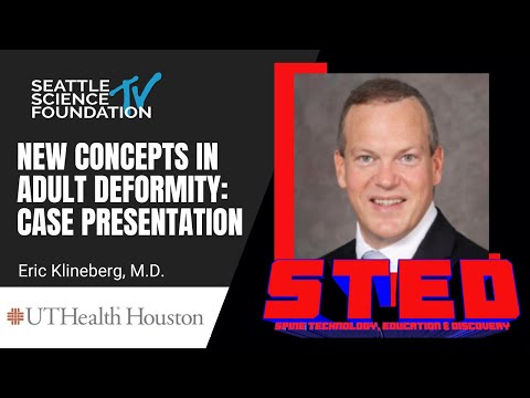 New Concepts in Adult Deformity: Case Presentation – Eric Klineberg, MD