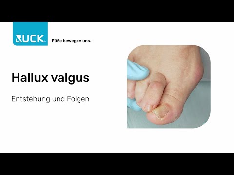 Folgen von Hallux Valgus: Druckstellen, Krallenzehen, Schmerzen