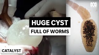 Removing massive brain cyst caused by tapeworms