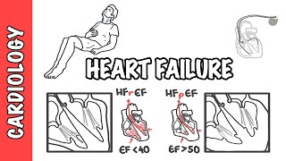 Heart failure with reduced and preserved ejection fraction, pathophysiology and treatment