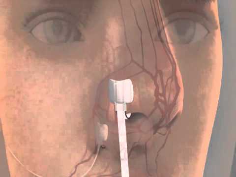 Nasal Alar Sp02 Sensor