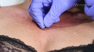 Medinica estética | Rejuvenecimiento de escote