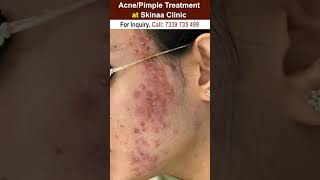 Acne/Pimple Treatment at skinaa Clinic #shorts  #acnetreatment #acnescars #pimple #skinaaclinic