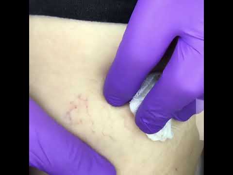 Köpük Skleroterapi