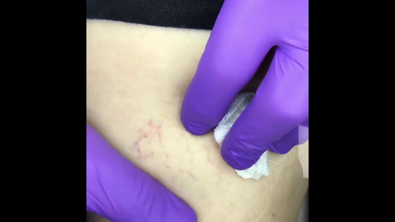 Köpük Skleroterapi