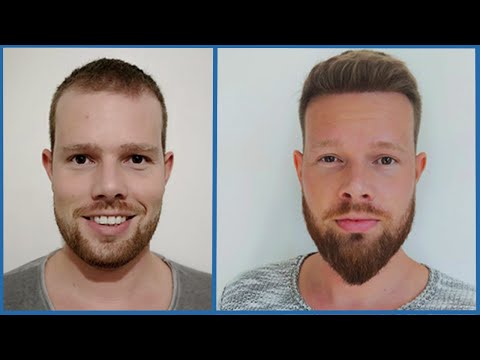 PRP-Behandlung Kosten: Wie teuer ist eine PRP?