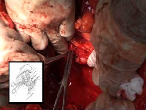 Surgical Management Of Renal Cell Carcinoma - Liver Transplantation Techniques