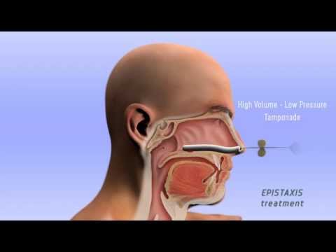 Epistaxis Treatment - 3D