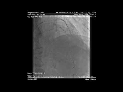 Left Main Stem to LAD/LCx Culotte Bifurcation PCI- Step by step approach