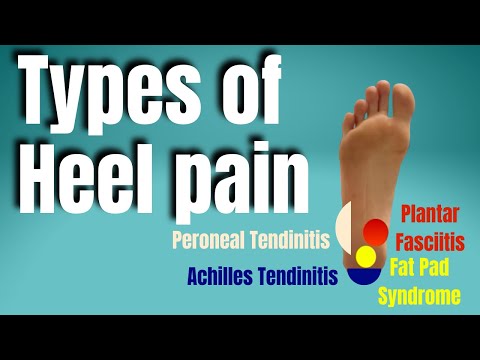 Types of Heel Pain | San Diego Sports Chiropractic