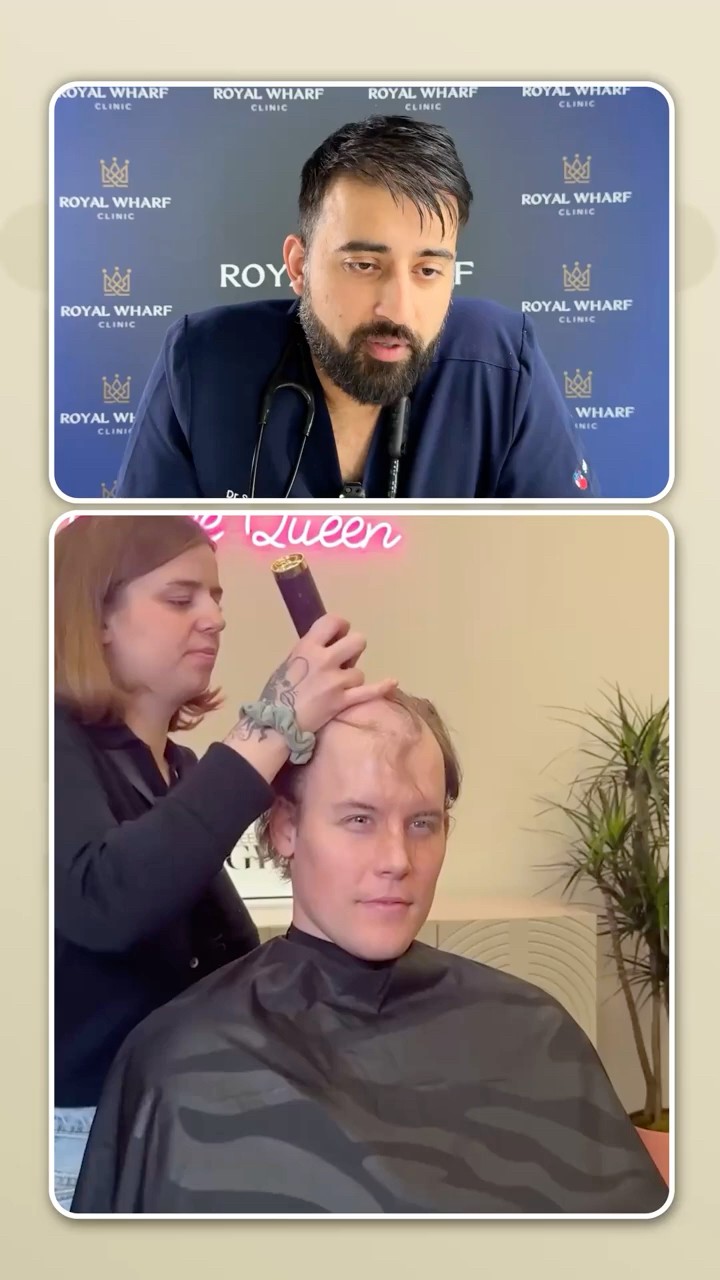 Hair Systems vs Hair Transplant