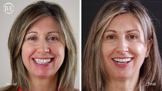 Tratamiento periodontal con carillas (caso real)