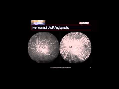 SPECTRALIS® Wide-field Imaging: Non-Contact Ultra-Widefield