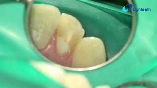 POV clinical presentation of RCT of THIS calcified tooth 7 from start to finish. @FlexivoDental 