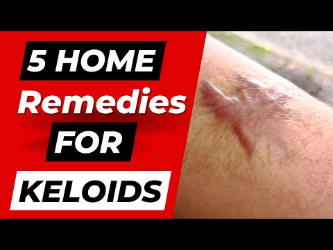 , title : '5 Home Remedies For Keloids'