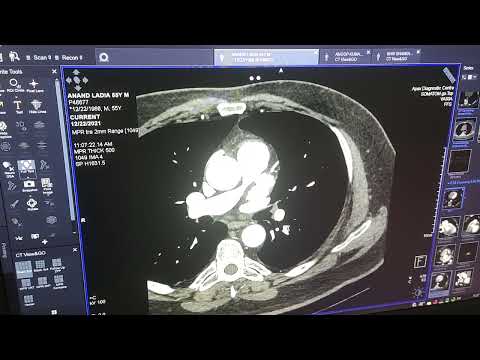 CT Angiography (Cardiac  CT ) | Apex Hospital