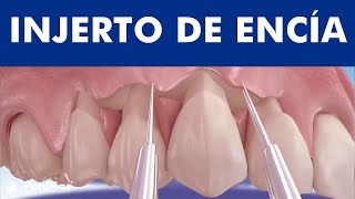 Colgajo desplazado coronalmente para tratar la recesión de encías © - Clínica Dental Pardiñas