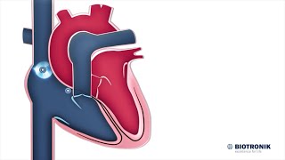 Sistema Elétrico do Coração | Animação Médica