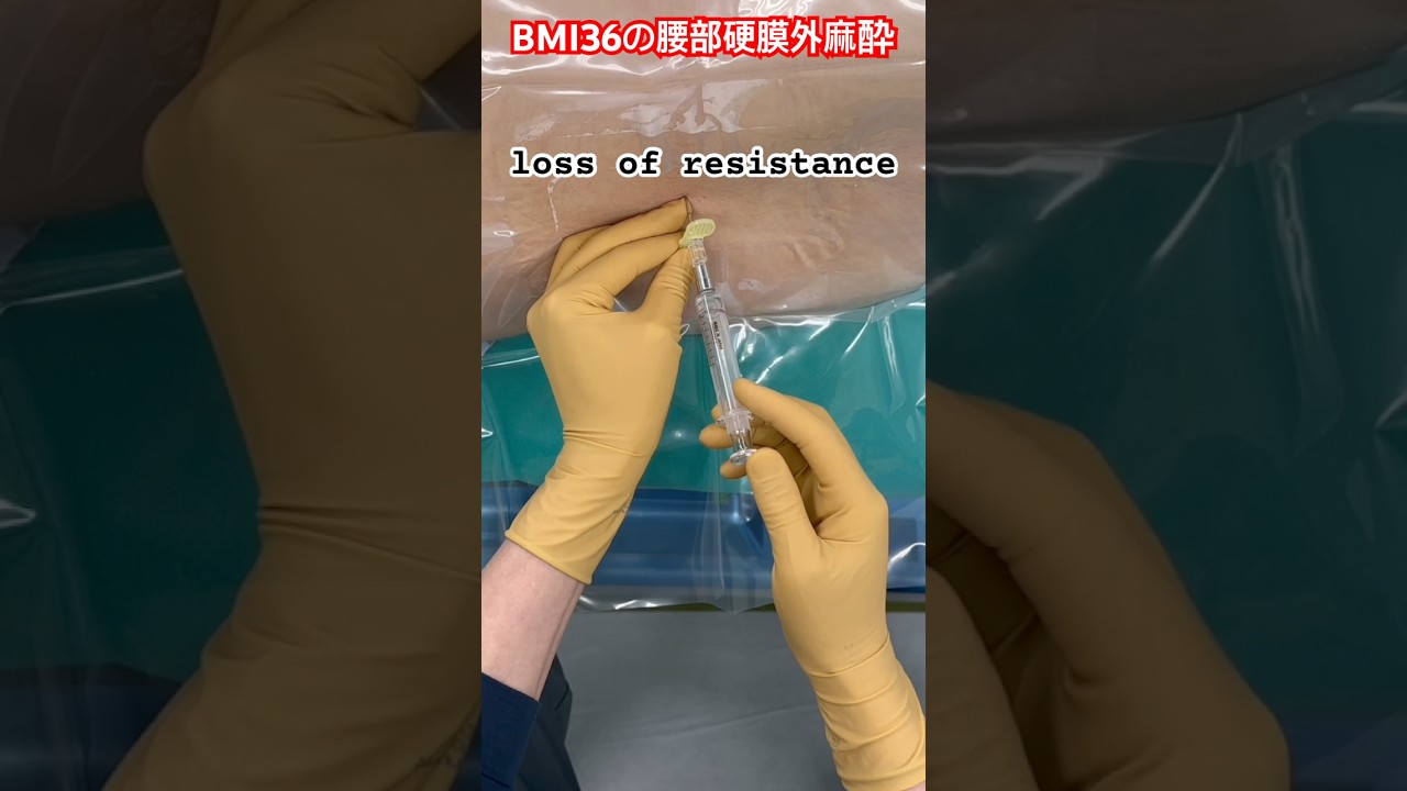 BMI36の腰部硬膜外麻酔 epidural anesthesia by Dr.EpiCal