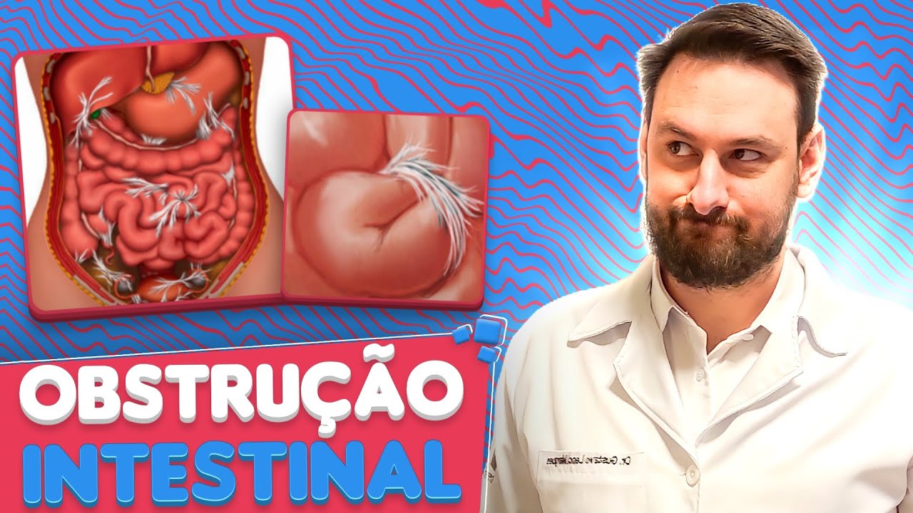 Médico explica o que é a OBSTRUÇÃO INTESTINAL! SINTOMAS E TRATAMENTO.