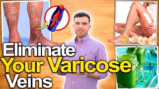 VARICOSE VEINS DISAPPEAR IN 3 STEPS   Get Rid and Eliminate Varicose Veins Naturally