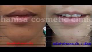 ปากกระจับ