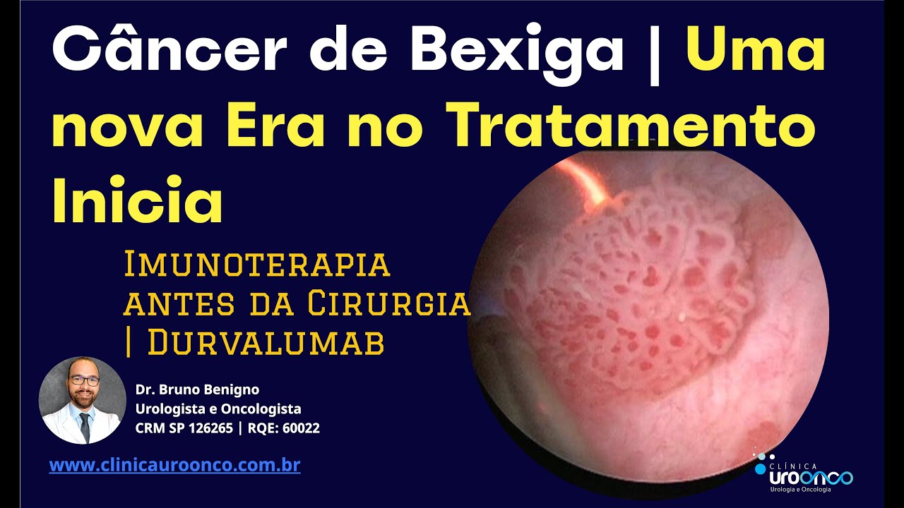 Nova Era no Tratamento do Câncer de Bexiga Começa | Imunoterapia Antes da Cistectomia | Durvalumab