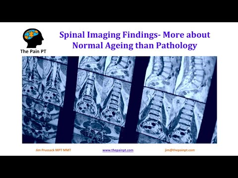 Spinal Imaging Findings Not the Root of Most Back Pain- TMS- Dr. Sarno