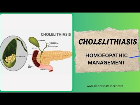CHOLELITHIASIS